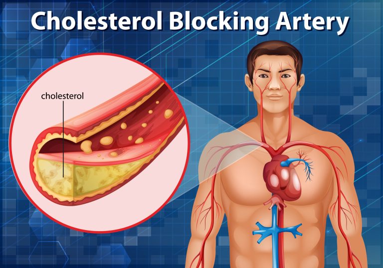 Ayurveda Treatment to Control High Cholesterol at Greenwich Ayurveda Hospital Kottakkal