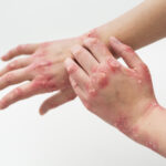 Ayurvedic herbs and oils used for natural psoriasis healing treatment.