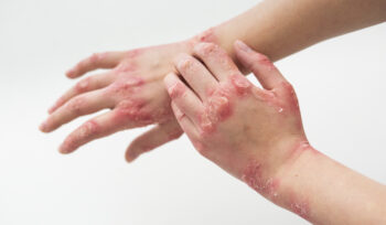 Ayurvedic herbs and oils used for natural psoriasis healing treatment.