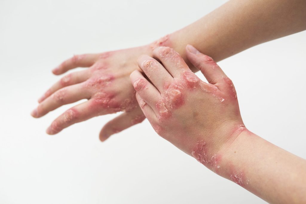 Ayurvedic herbs and oils used for natural psoriasis healing treatment.
