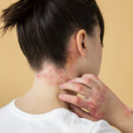 Psoriasis treatment using Ayurveda at Greenwich Ayurveda Hospital for natural skin healing