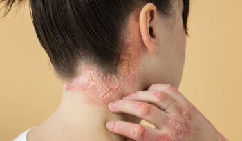 Psoriasis treatment using Ayurveda at Greenwich Ayurveda Hospital for natural skin healing