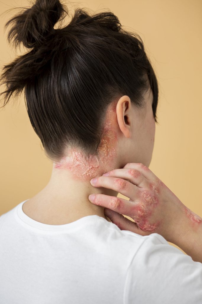 Psoriasis treatment using Ayurveda at Greenwich Ayurveda Hospital for natural skin healing